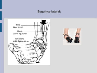 Esguince lateral:
 