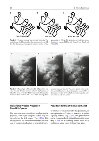 Avul Process 2013_Imaging_of_the_Cervical_Spine_in_Children.pdf