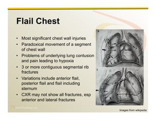 www.RiTradiology.com	

www.RiTradiology.com	

Flail Chest
•  Most significant chest wall injuries
•  Paradoxical movement of a segment
of chest wall
•  Problems of underlying lung contusion
and pain leading to hypoxia
•  3 or more contiguous segmental rib
fractures
•  Variations include anterior flail,
posterior flail and flail including
sternum
•  CXR may not show all fractures, esp
anterior and lateral fractures
Images from wikipedia
 