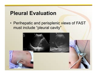 www.RiTradiology.com	

www.RiTradiology.com	

Pleural Evaluation
•  Perihepatic and perisplenic views of FAST
must include “pleural cavity”
 