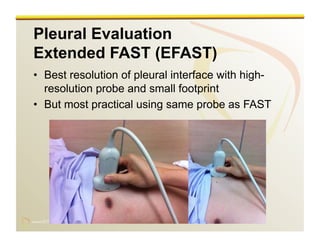 www.RiTradiology.com	

www.RiTradiology.com	

Pleural Evaluation
Extended FAST (EFAST)
•  Best resolution of pleural interface with high-
resolution probe and small footprint
•  But most practical using same probe as FAST
 