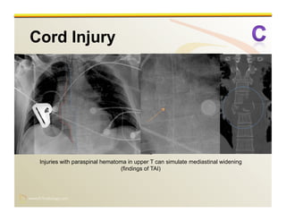 www.RiTradiology.com	

www.RiTradiology.com	

Injuries with paraspinal hematoma in upper T can simulate mediastinal widening
(findings of TAI)
 