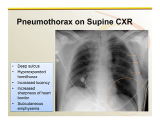 www.RiTradiology.com	

www.RiTradiology.com	

Pneumothorax on Supine CXR
•  Deep sulcus
•  Hyperexpanded
hemithorax
•  Increased lucency
•  Increased
sharpness of heart
border
•  Subcutaneous
emphysema
 