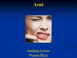Acné

Jordana Lewis
Puerto Rico

 