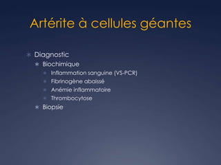 Artérite à cellules géantes
 Diagnostic
 Biochimique
 Inflammation sanguine (VS-PCR)
 Fibrinogène abaissé
 Anémie inflammatoire
 Thrombocytose
 Biopsie
 