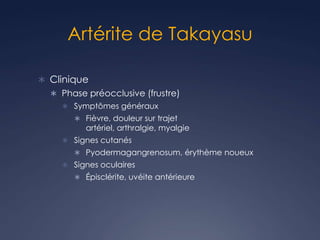 Artérite de Takayasu
 Clinique
 Phase préocclusive (frustre)
 Symptômes généraux
 Fièvre, douleur sur trajet
artériel, arthralgie, myalgie
 Signes cutanés
 Pyodermagangrenosum, érythème noueux
 Signes oculaires
 Épisclérite, uvéite antérieure
 
