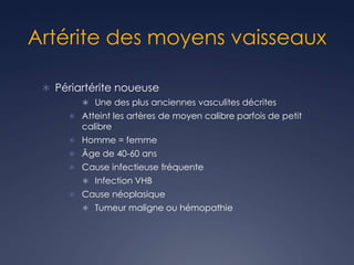 Artérite des moyens vaisseaux
 Périartérite noueuse
 Une des plus anciennes vasculites décrites
 Atteint les artères de moyen calibre parfois de petit
calibre
 Homme = femme
 Âge de 40-60 ans
 Cause infectieuse fréquente
 Infection VHB
 Cause néoplasique
 Tumeur maligne ou hémopathie
 