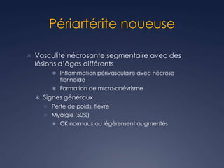 Périartérite noueuse
 Vasculite nécrosante segmentaire avec des
lésions d’âges différents
 Inflammation périvasculaire avec nécrose
fibrinoïde
 Formation de micro-anévrisme
 Signes généraux
 Perte de poids, fièvre
 Myalgie (50%)
 CK normaux ou légèrement augmentés
 
