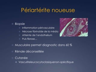 Périartérite noueuse
 Biopsie
 Inflammation périvasculaire
 Nécrose fibrinoïde de la média
 Atteinte de l’endothelium
 Puis fibrose…
 Musculaire permet diagnostic dans 60 %
 Rénale déconseillée
 Cutanée
 Vasculiteleucocytoclasiquenon-spécifique
 