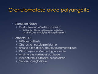 Granulomatose avec polyangéite
 Signes généraux
 Plus frustre que d’autres vasculites
 Asthénie, fièvre, arthralgies, arthrites
symétriques, myalgies, amaigrissement
 Atteinte ORL
 70% des patients
 Obstruction nasale persistante
 Sinusite à répétition, croûteuse, hémorragique
 Otite moyenne séreuse, hypoacousie
 Atteinte des cartilages du visage
 Pseudotumeur orbitaire, exophtalmie
 Sténose sous-glottique
 