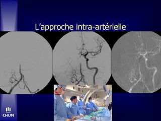 L’approche intra-artérielle
 