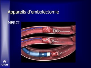 Appareils d’embolectomie
MERCI
 