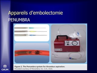 Appareils d’embolectomie
PENUMBRA
 