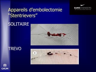 Appareils d’embolectomie
“Stentrievers”
SOLITAIRE
TREVO
 