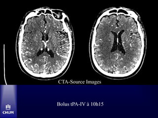 Bolus tPA-IV à 10h15
CTA-Source Images
 