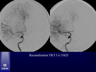 Recanalisation TICI 3 à 11h25
 