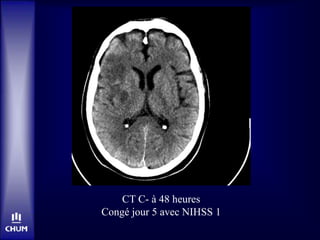 CT C- à 48 heures
Congé jour 5 avec NIHSS 1
 