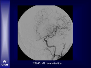 22h40: M1 recanalization
 