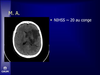 M. A.
 NIHSS ~ 20 au conge
 