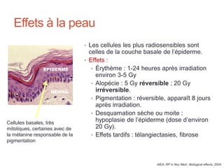 Effets à la peau
• Les cellules les plus radiosensibles sont
celles de la couche basale de l’épiderme.
• Effets :
• Érythème : 1-24 heures après irradiation
environ 3-5 Gy
• Alopécie : 5 Gy réversible ; 20 Gy
irréversible.
• Pigmentation : réversible, apparaît 8 jours
après irradiation.
• Desquamation sèche ou moite :
hypoplasie de l’épiderme (dose d’environ
20 Gy).
• Effets tardifs : télangiectasies, fibrose
DERME
EPIDERME
Cellules basales, très
mitotiques, certaines avec de
la mélanine responsable de la
pigmentation
IAEA, RP in Nuc Med : Biological effects, 2004.
 