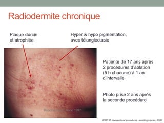 Radiodermite chronique
Hyper & hypo pigmentation,
avec télangiectasie
ICRP 85 Interventional procedures - avoiding injuries, 2000.
Patiente de 17 ans après
2 procédures d’ablation
(5 h chacune) à 1 an
d’intervalle
Photo prise 2 ans après
la seconde procédure
Plaque durcie
et atrophiée
Reported by E. Vano 1997
 