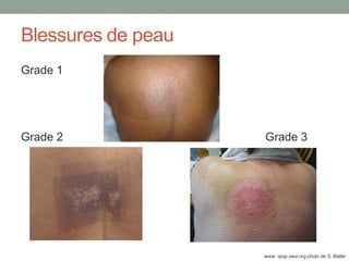 Blessures de peau
Grade 1
Grade 2 Grade 3
www. rpop.iaea.org photo de S. Balter
 