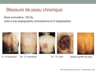 Blessure de peau chronique
ICRP 85 Interventional procedures - avoiding injuries, 2000.
Dose cumulative ~20 Gy
suite à une angiographie coronarienne et 2 angioplasties
6 – 8 semaines 16 – 21 semaines 18 – 21 mois Après la greffe de peau
 