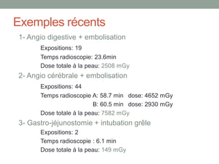 Exemples récents
1- Angio digestive + embolisation
Expositions: 19
Temps radioscopie: 23.6min
Dose totale à la peau: 2508 mGy
2- Angio cérébrale + embolisation
Expositions: 44
Temps radioscopie A: 58.7 min dose: 4652 mGy
B: 60.5 min dose: 2930 mGy
Dose totale à la peau: 7582 mGy
3- Gastro-jéjunostomie + intubation grêle
Expositions: 2
Temps radioscopie : 6.1 min
Dose totale à la peau: 149 mGy
 