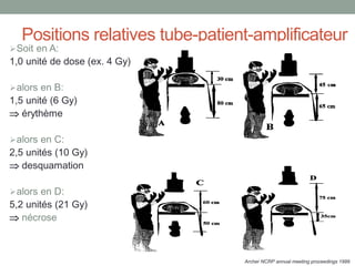 Positions relatives tube-patient-amplificateur
Soit en A:
1,0 unité de dose (ex. 4 Gy)
alors en B:
1,5 unité (6 Gy)
 érythème
alors en C:
2,5 unités (10 Gy)
 desquamation
alors en D:
5,2 unités (21 Gy)
 nécrose
Archer NCRP annual meeting proceedings 1999
 