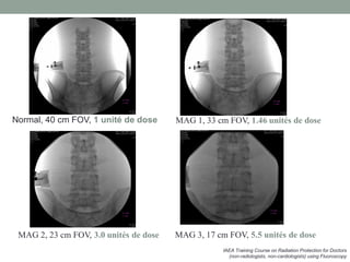 IAEA Training Course on Radiation Protection for Doctors
(non-radiologists, non-cardiologists) using Fluoroscopy
Normal, 40 cm FOV, 1 unité de dose MAG 1, 33 cm FOV, 1.46 unités de dose
MAG 2, 23 cm FOV, 3.0 unités de dose MAG 3, 17 cm FOV, 5.5 unités de dose
 