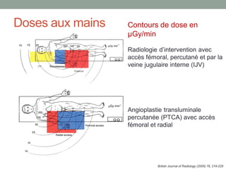 Doses aux mains Contours de dose en
µGy/min
Radiologie d’intervention avec
accès fémoral, percutané et par la
veine jugulaire interne (IJV)
Angioplastie transluminale
percutanée (PTCA) avec accès
fémoral et radial
British Journal of Radiology (2005) 78, 219-229
 