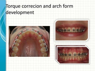 Torque correcion and arch form
development
 