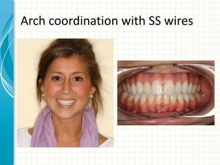 Arch coordination with SS wires
 