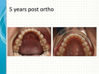5 years post ortho
 