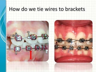 How do we tie wires to brackets
 