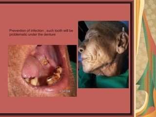 Prevention of infection , such tooth will be
problematic under the denture
 