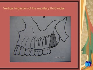 Vertical impaction of the maxillary third molar
 
