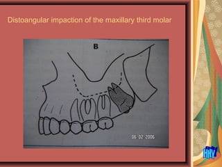 Distoangular impaction of the maxillary third molar
 
