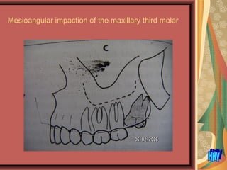 Mesioangular impaction of the maxillary third molar
 
