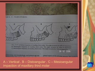 A – Vertical , B – Distoangular , C – Mesioangular
impaction of maxillary third molar
 