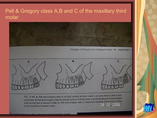 Pell & Gregory class A,B and C of the maxillary third
molar
 