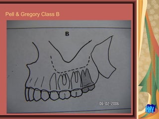 Pell & Gregory Class B
 