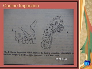 Canine Impaction
 