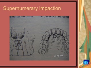 Supernumerary impaction
 
