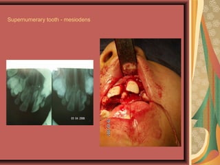 Supernumerary tooth - mesiodens
 