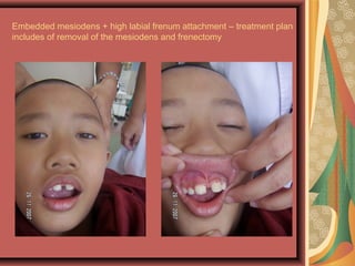 Embedded mesiodens + high labial frenum attachment – treatment plan
includes of removal of the mesiodens and frenectomy
 