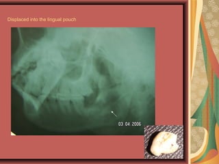 Displaced into the lingual pouch
 