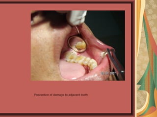 Prevention of damage to adjacent tooth
 