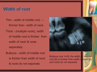Width of root
Thin - width of middle root →
thinner than width of neck
Thick - (multiple roots), width
of middle root is thicker than
width of neck & roots
separately
Bulbous - width of middle root
is thicker than width of neck
& roots do not separate
Bulbous root. A<B: the width of middle
root (B) is thicker than width of neck (A)
and roots do not separate.
 