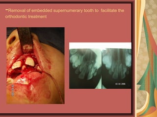 -Removal of embedded supernumerary tooth to facilitate the
orthodontic treatment
 